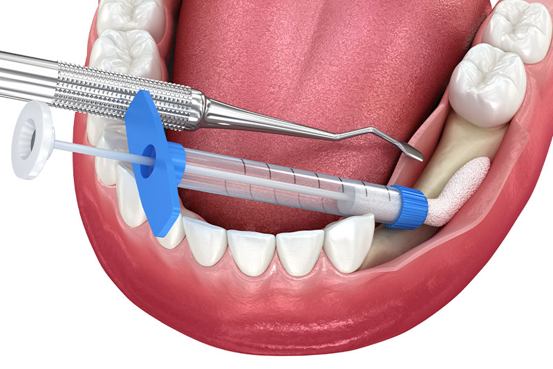 Bone Grafting in Carlsbad