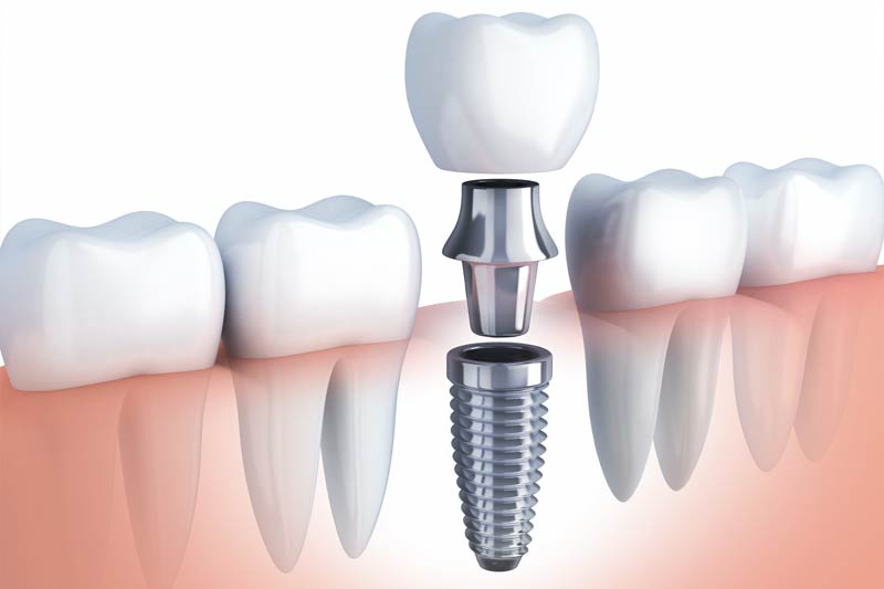 Single Tooth Replacement in Carlsbad