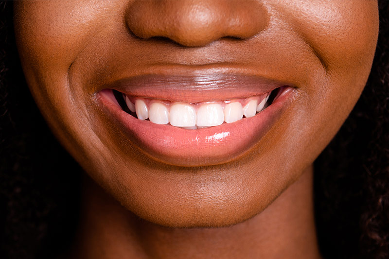 Crown Lengthening in Carlsbad