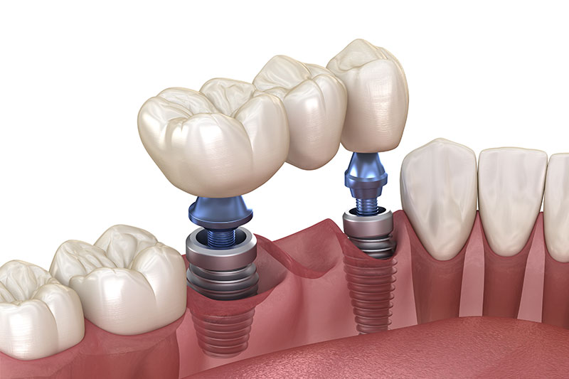 Multiple Teeth Replacement in Carlsbad