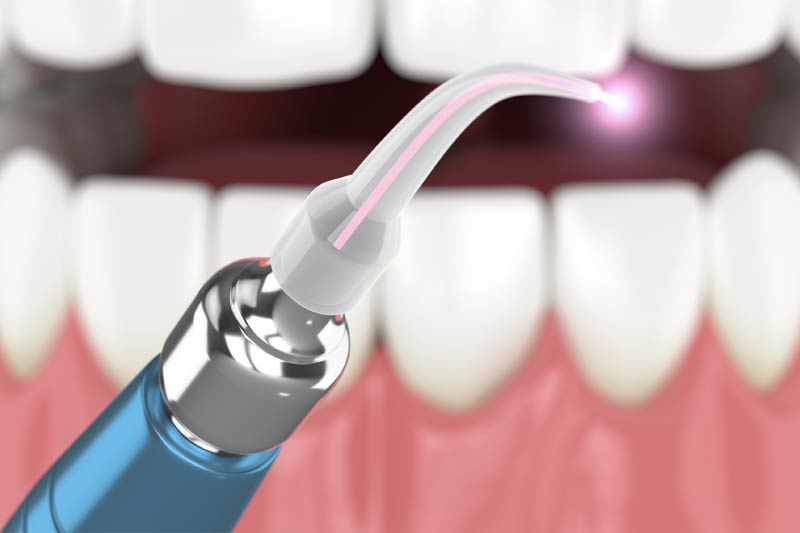Laser Periodontal Therapy in Carlsbad