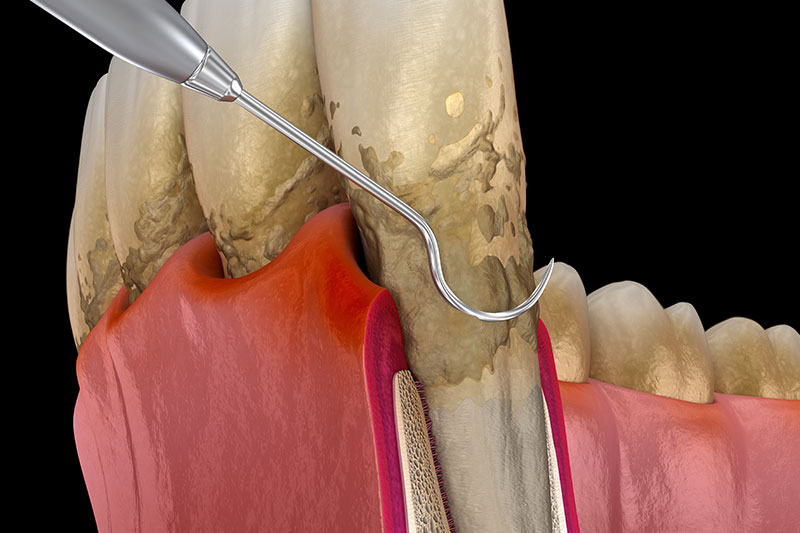 Non-Surgical Periodontal Disease Therapy in Carlsbad