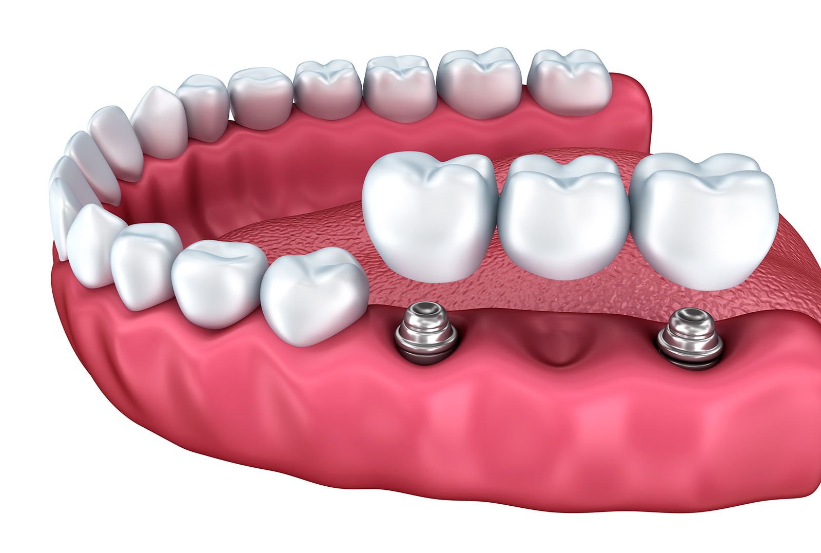 Dental Implant Bridge Carlsbad