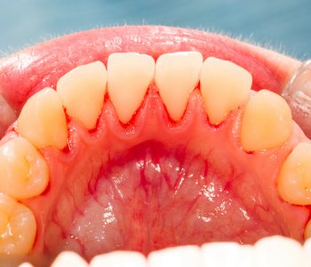 Gum Infection Symptoms Carlsbad