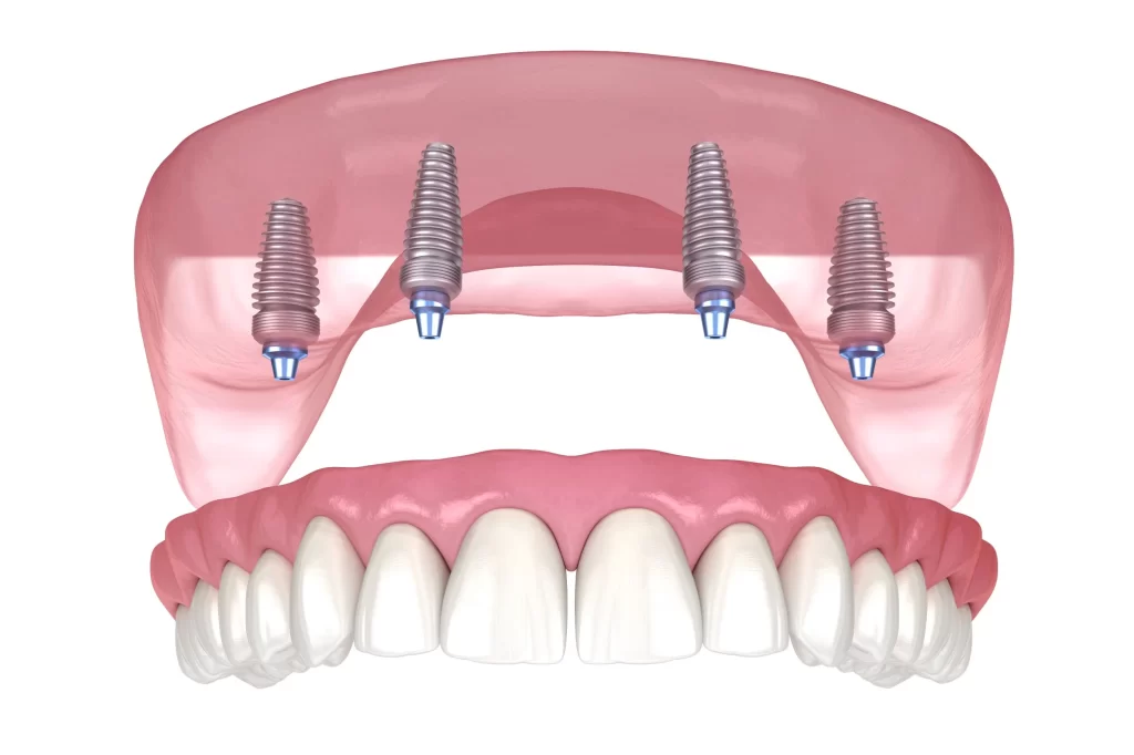 All On 4 Dental Implants Oceanside